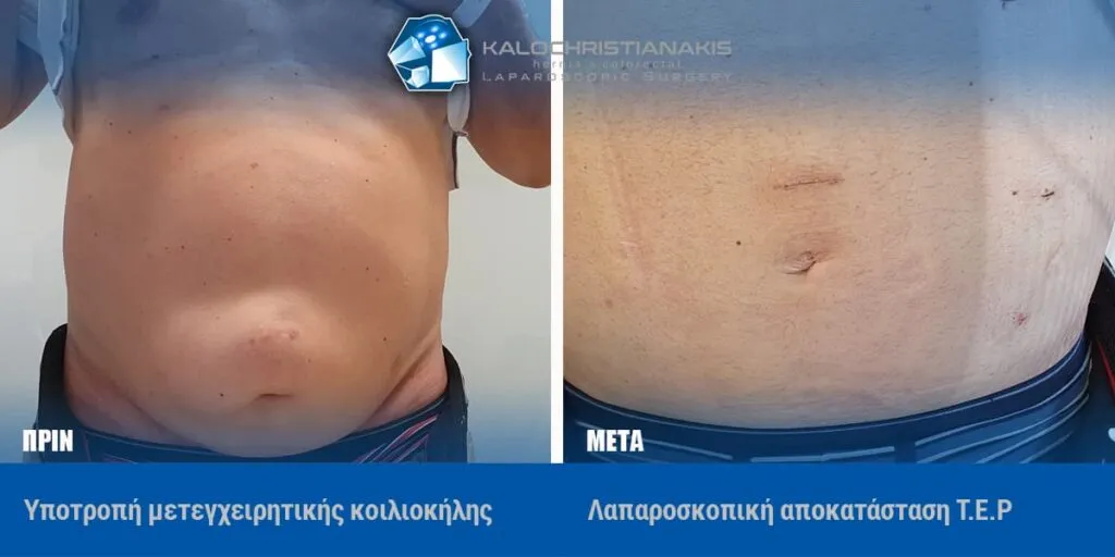 Υποτροπή μετεγχειρητικής κοιλιοκήλης πριν την επέμβαση και το αποτέλεσμα μετά από λαπαροσκοπική αποκατάσταση TEP