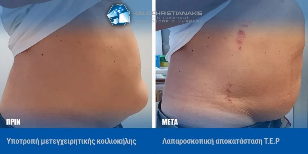 Υποτροπή μετεγχειρητικής κοιλιοκήλης σε πλάγια λήψη, πριν και μετά από λαπαροσκοπική αποκατάσταση TEP