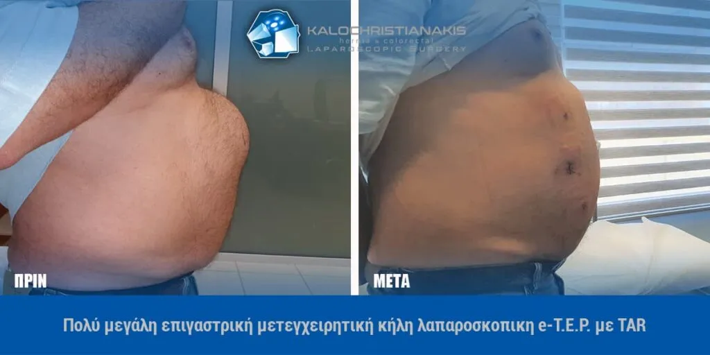 Πολύ μεγάλη επιγαστρική μετεγχειρητική κήλη πριν και μετά από λαπαροσκοπική αποκατάσταση e-TEP με TAR