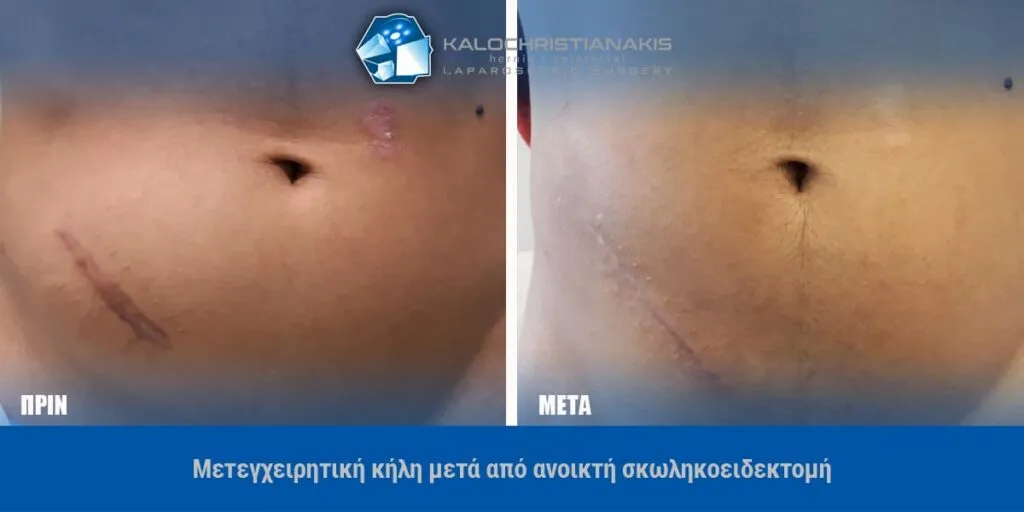 Μετεγχειρητική κήλη μετά από ανοικτή σκωληκοειδεκτομή, πριν και μετά την αποκατάσταση